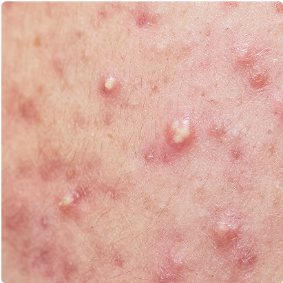 Acne & Breakouts