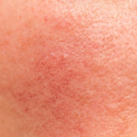 Skin problems such as eczema, rosacea